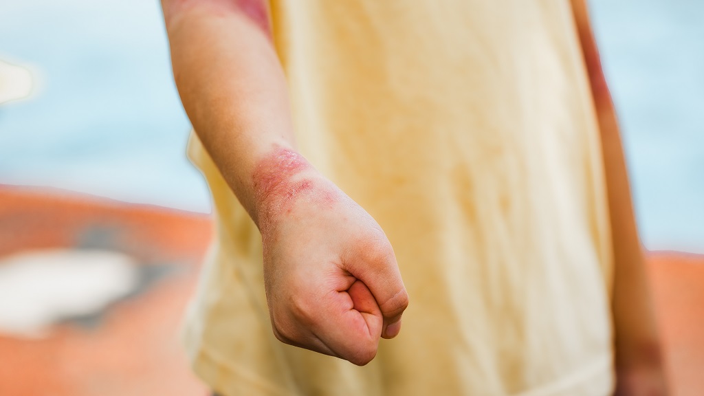 close-up-of-a-child-s-wrist-with-severe-red-scaly